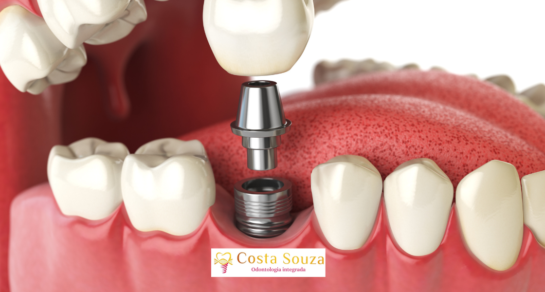 Implante Dentário Dói?