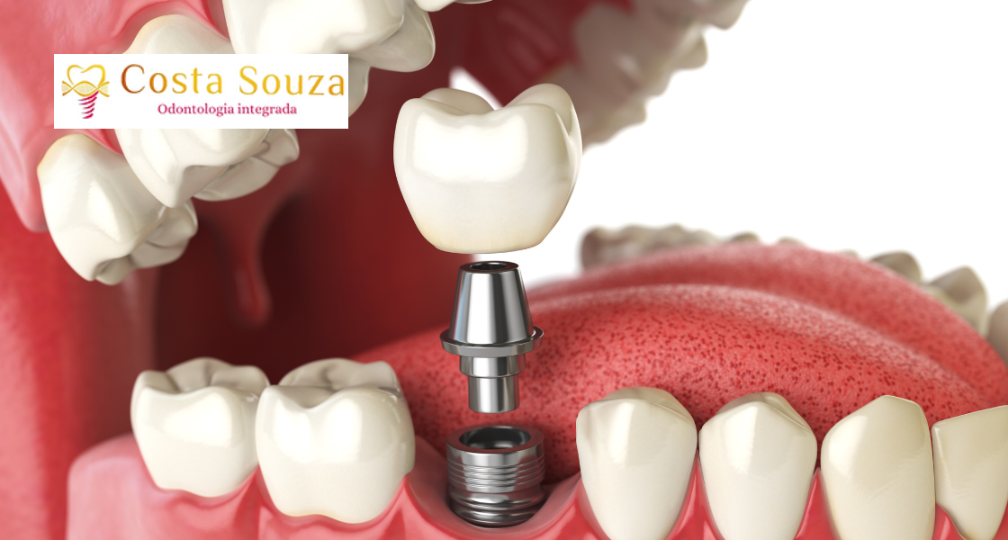 Implante dentário em Icaraí
