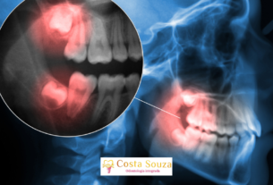 Dente Siso: Quando Tirar