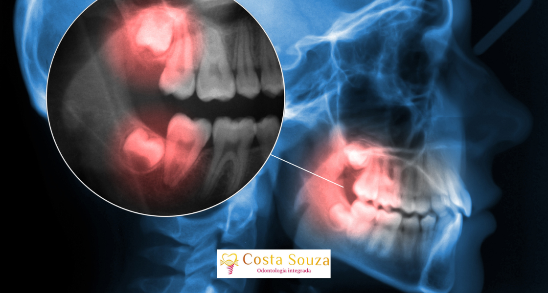 Dente Siso: Quando Tirar