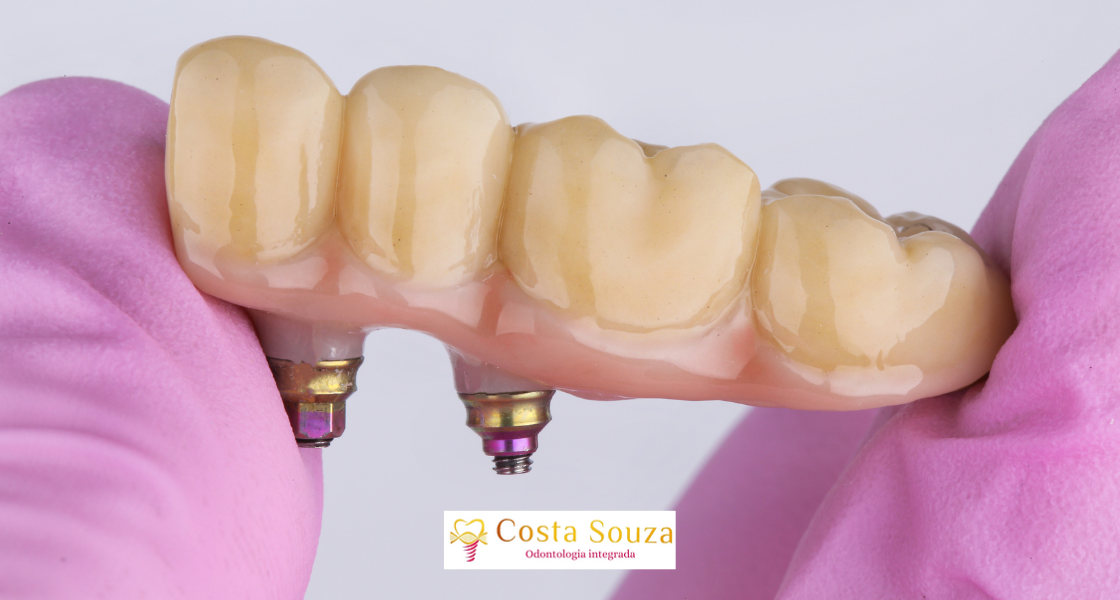 Prótese Dentária: Como Recuperar seu Sorriso